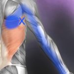 Trigger point example 3