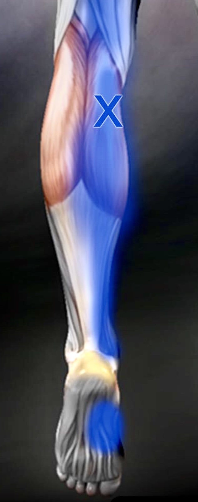 Trigger point example 1