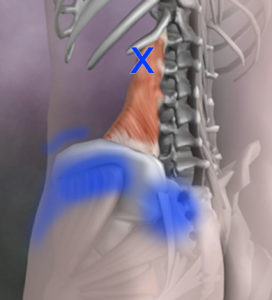 Trigger point example 2